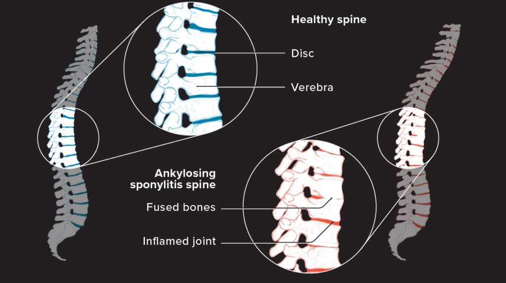 Efficacy of standalone personalized Ayurveda management in moderating inflammatory markers & radiological progression in Ankylosing Spondylitis with 11 years follow up – A Case Report