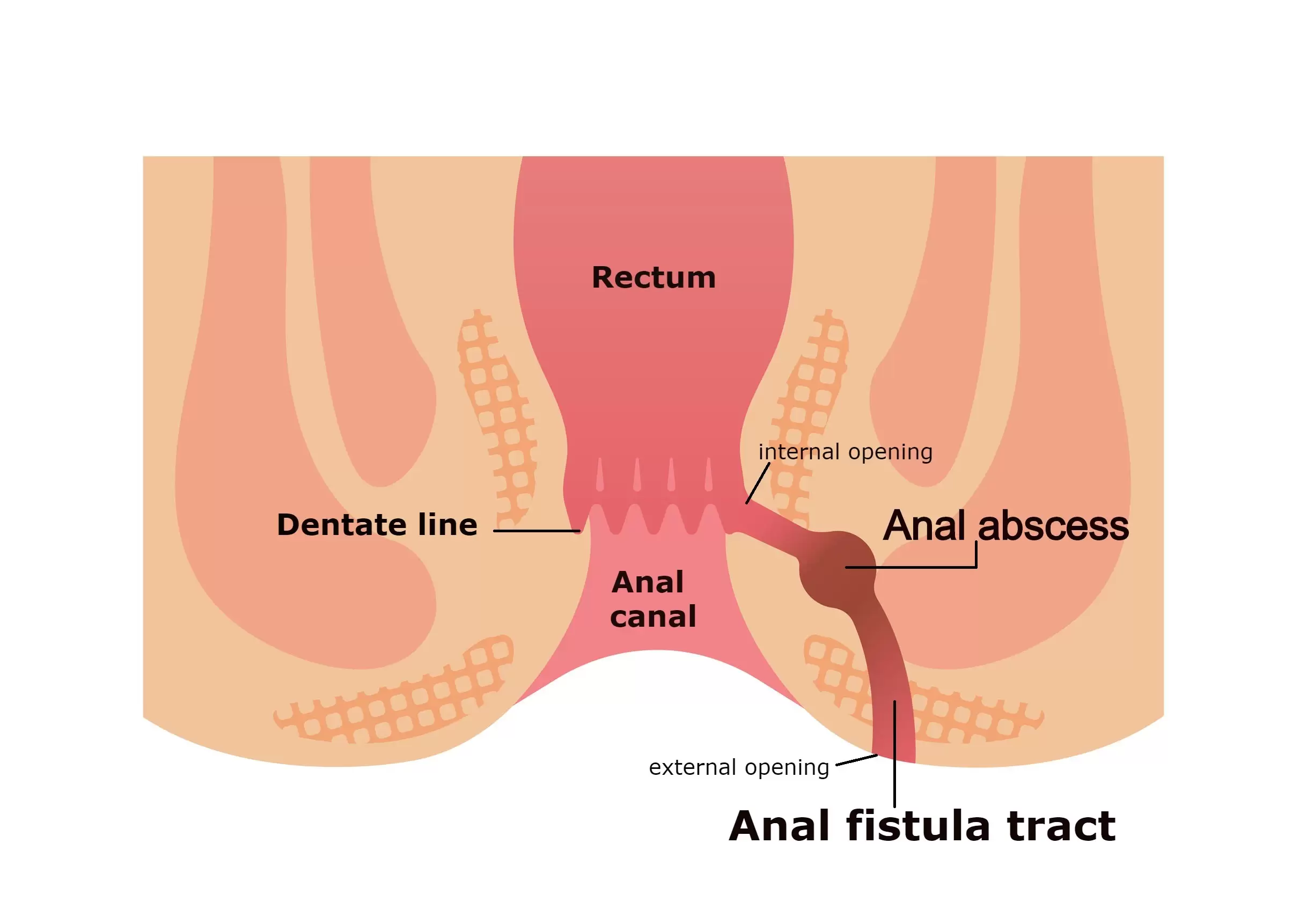 Challenges and Solutions: Managing a Complex Recurrent Fistula in Ano with Multiple Tracts using Kshara-Sutra in a follow-up of three months – A Case Report