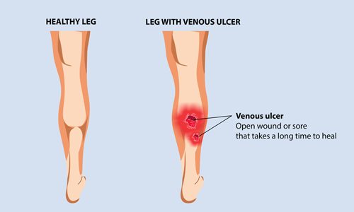 Minimal Invasive Management of Recurrent and Acute-on-Chronic Non-healing Venous Leg Ulceration through Ayurveda – a Case Report