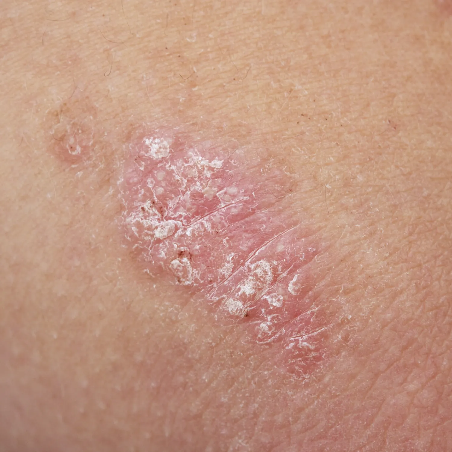 Management of Kitibha kushta (Psoriasis) with Shodhana Chikitsa and Customised Ayurveda Medications - A Case Report