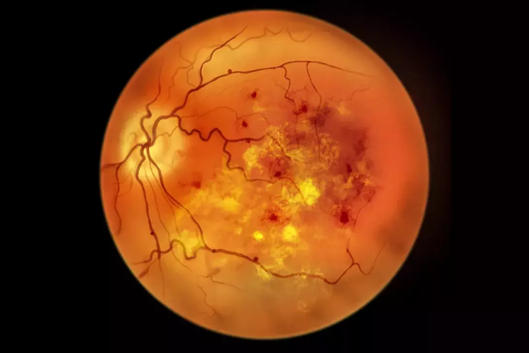 Management of high risk diabetic retinopathy: A Case report