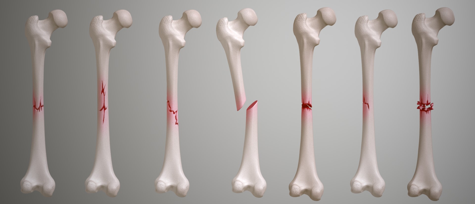 Integrating Ayurveda and Marma Therapy for Optimal Pain Management in Fracture : A two Month Follow-Up Case Report