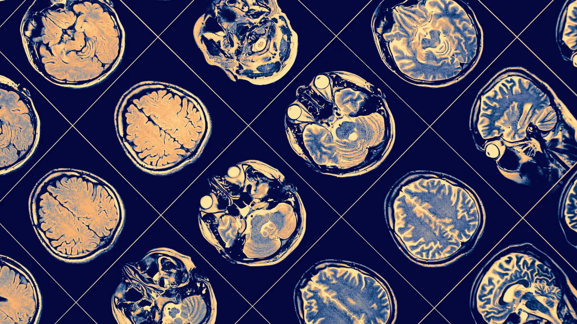 Basti Therapy in the Management of Schizophrenia: A Case Study Demonstrating Karma Siddhi of Bio-Purification Therapies